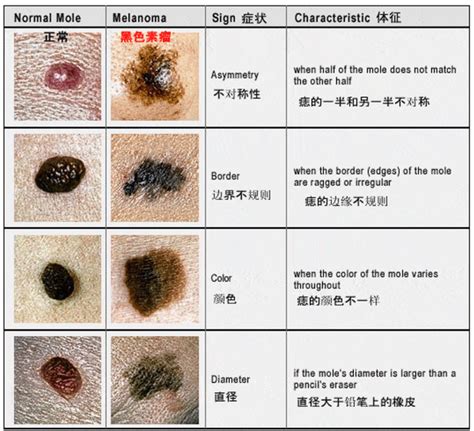 胸有大痣|一图读懂：什么样的痣易癌变？